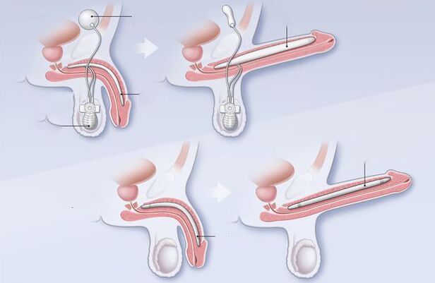 examination of the penis for impotence